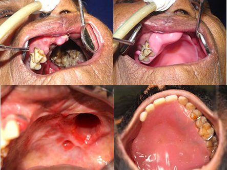 Dental Implant
