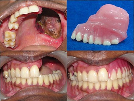 Dental Implant