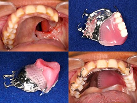 Dental Implant