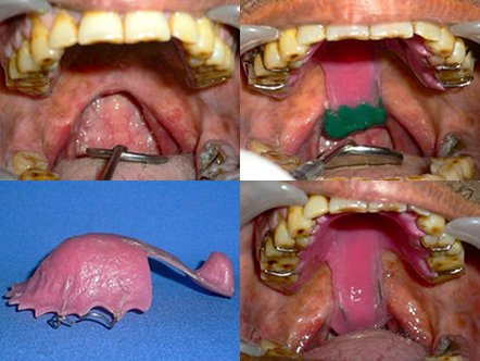 Dental Implant
